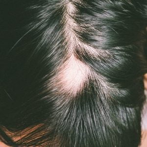The Latest Treatments for Alopecia Areata: Medications, Therapies, and Emerging Research