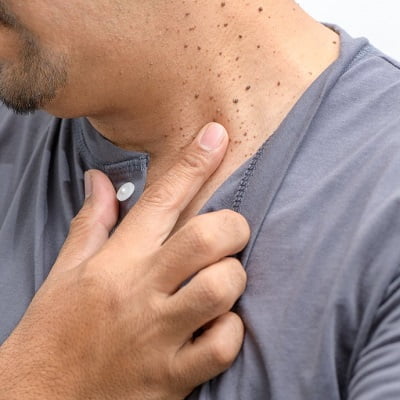 What Are Skin Tags and Why Do They