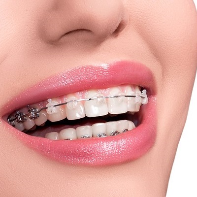 What To Expect During Your First Appointment For Dental Braces