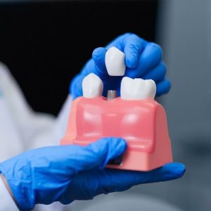 When do I get to eat after Dental Implant Surgery?