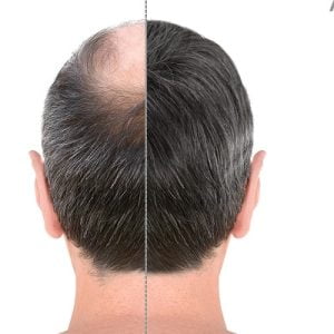 A Quick Guide to High-Grade Baldness