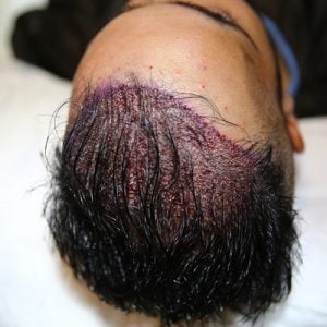 How to Care for Your Hair After FUE Transplantation
