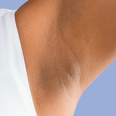 How to get rid of dark under the armpit permanently