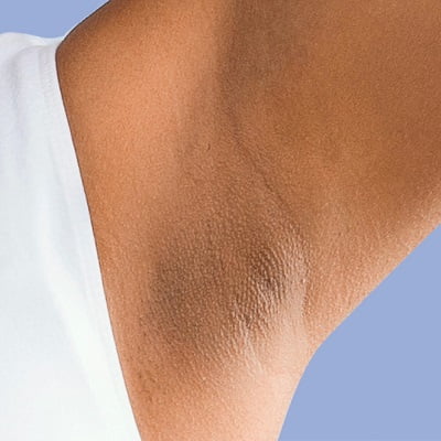 How to get rid of dark under the armpit permanently?