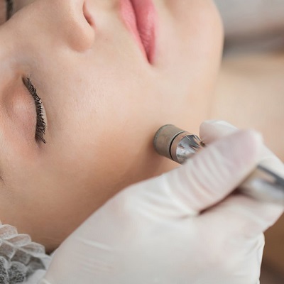 The Benefits of Microdermabrasion for Beautiful Skin