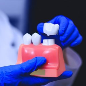 The Most Precise Dental Implant In Islamabad
