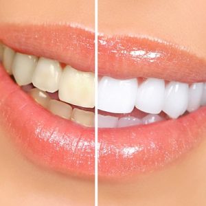 The Role of Dentists in Professional Teeth Whitening