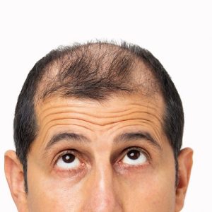 The Role of Microneedling in Improving Hair Growth and Reducing Hair Loss