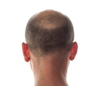 Cost of Crown Hair Transplant in Islamabad
