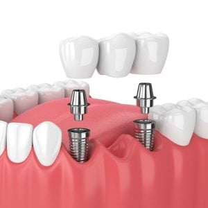 3 types of dental implants in islamabad