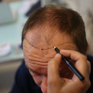 From Bald to Bold: The Remarkable Results of Hair Transplant Surgery