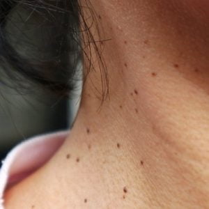 How to Prevent Skin Tags from Forming in the First Place