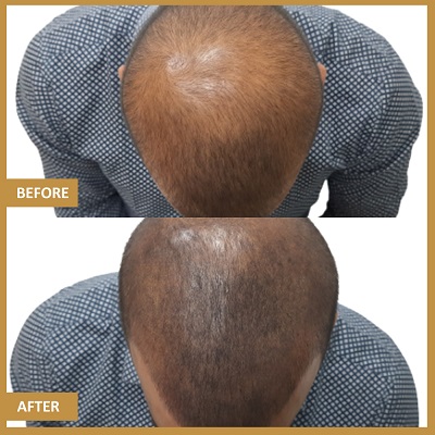 Is Scalp Micro Pigmentation A Better Option Than A Hair Transplant