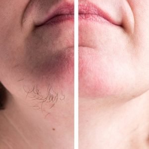 Laser Hair Removal vs. Waxing: Which Is More Effective?