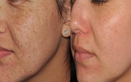 Skin Tag Removal cost in Islamabad