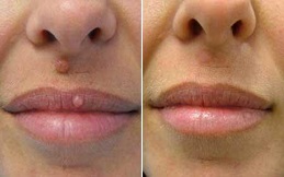 Skin Tag Removal in Islamabad