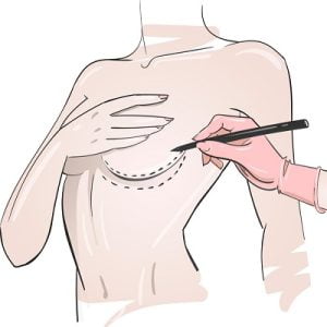 The Journey to Perfect Curves: Breast Augmentation