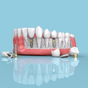 The Perfect Fit: Exploring Dental Implants