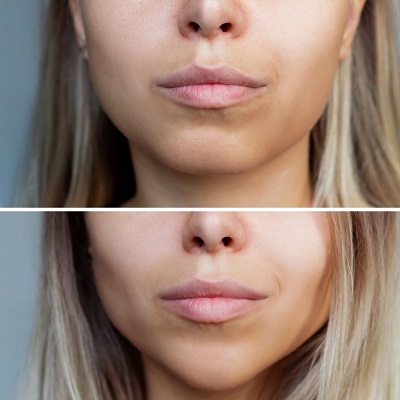 The Power of Buccal Fat Removal