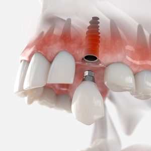 The Role of Technology in Dental Implantology: Advancements and Benefits