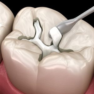 Understanding Different Types of Teeth Fillings: Pros and Cons