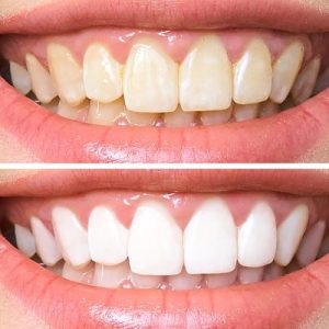 Unveil Your Inner Glow: Embrace Teeth Whitening and Scaling Excellence!