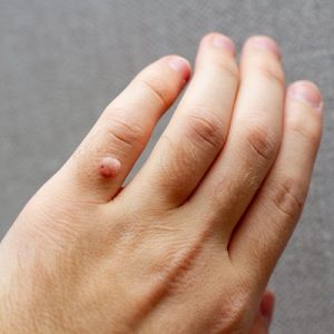 Why warts should be removed?
