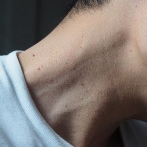 Skin Tag Removal Cost in Pakistan