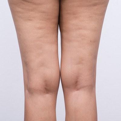 Achieving Cellulite-Free Skin with Expert Treatments