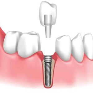 Are dental implants stronger than real teeth?