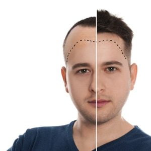 Are people happy with a hair transplant?