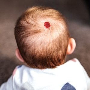 Are there any side effects of removing a birthmark?