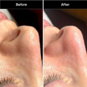 Can hydrafacial really give satisfying results?