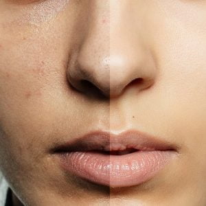 How do I completely get rid of skin pigmentation?