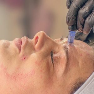 How many microneedling treatment sessions do I need to see results?