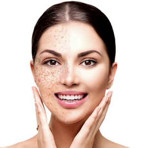How to treat hyperpigmentation in the body?