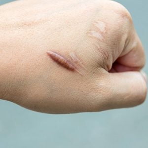 What are the latest treatments for keloid?