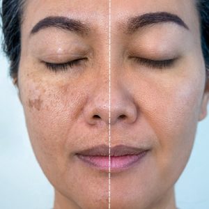 Melasma Treatment for Face in Islamabad