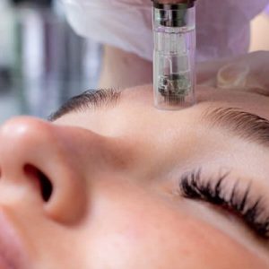 Microneedling with stretch marks: Can it really help?