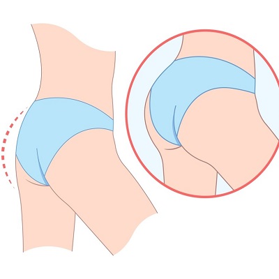 The Risks and Benefits of Brazilian Butt Lift Surgery