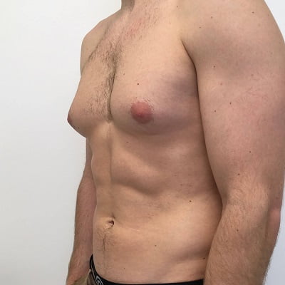 What are the best treatments for Gynecomastia?