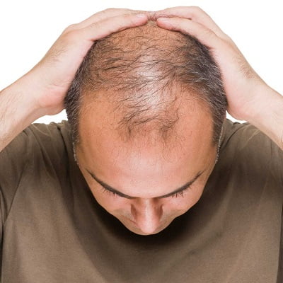 What causes hair loss, and how to treat it?