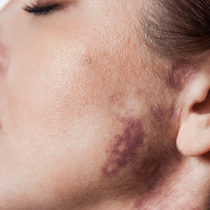 Birthmark Removal Cost in Islamabad