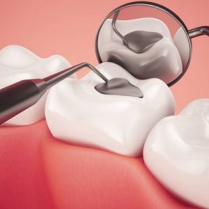 What is the latest technique for dental filling in Pakistan?