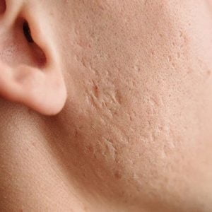 Can acne skin scars disappear over time?