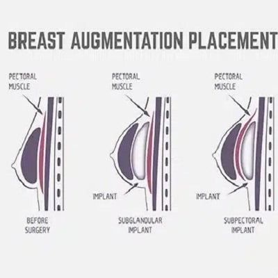 what is the most natural-looking breast surgery in Islamabad?