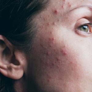 Best Acne Treatment for Oily Skin in Islamabad