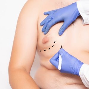 Can lack of sleep cause gynecomastia?