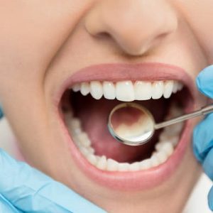 Do’s and dont’s of Dental Fillings