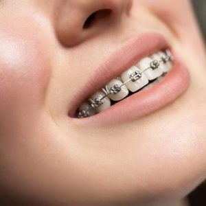 How long do I need to wear dental braces?